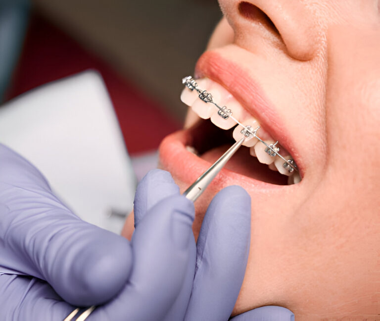 How Teeth Straightening Transforms Your Smile and Confidence